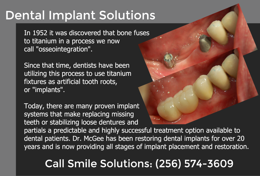 Dental Implants at Smile Solutions