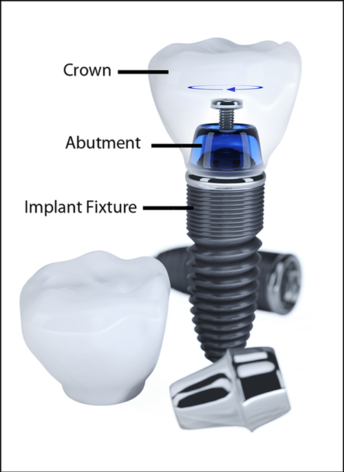 Implant Components