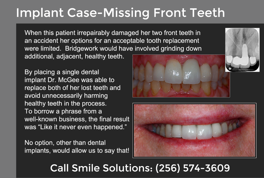 Missing Front Teeth Scottsboro, AL