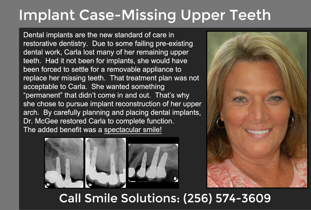 Implants Scottsboro AL