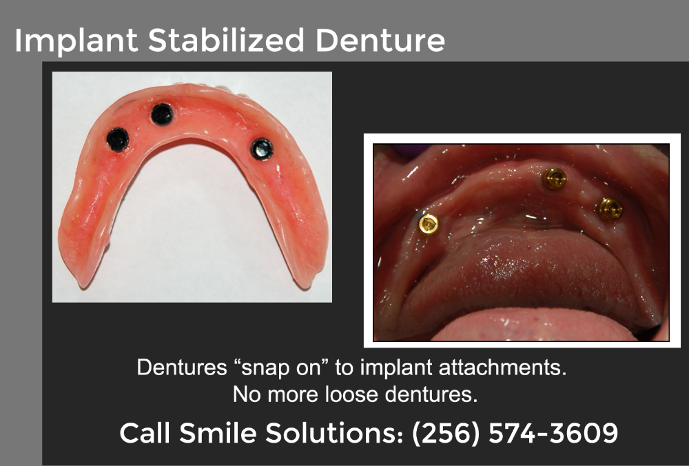 Implant Stabilized Dentures Scottsboro, AL