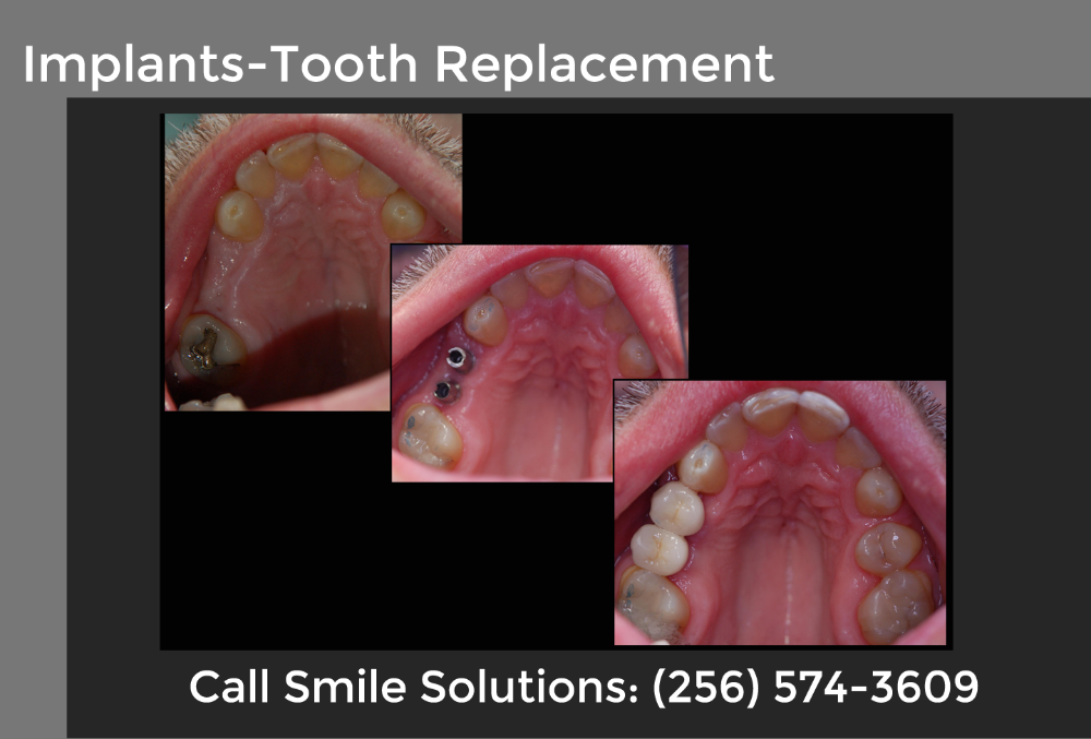 Implants for Tooth Replacement