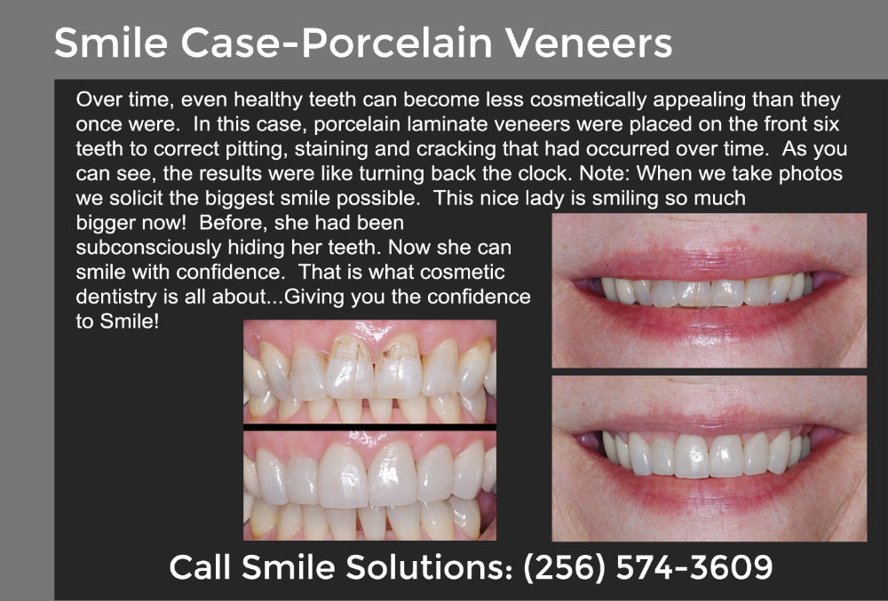 Porcelain Veneers Scottsboro, AL