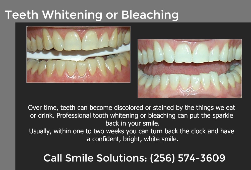Teeth Whitening
